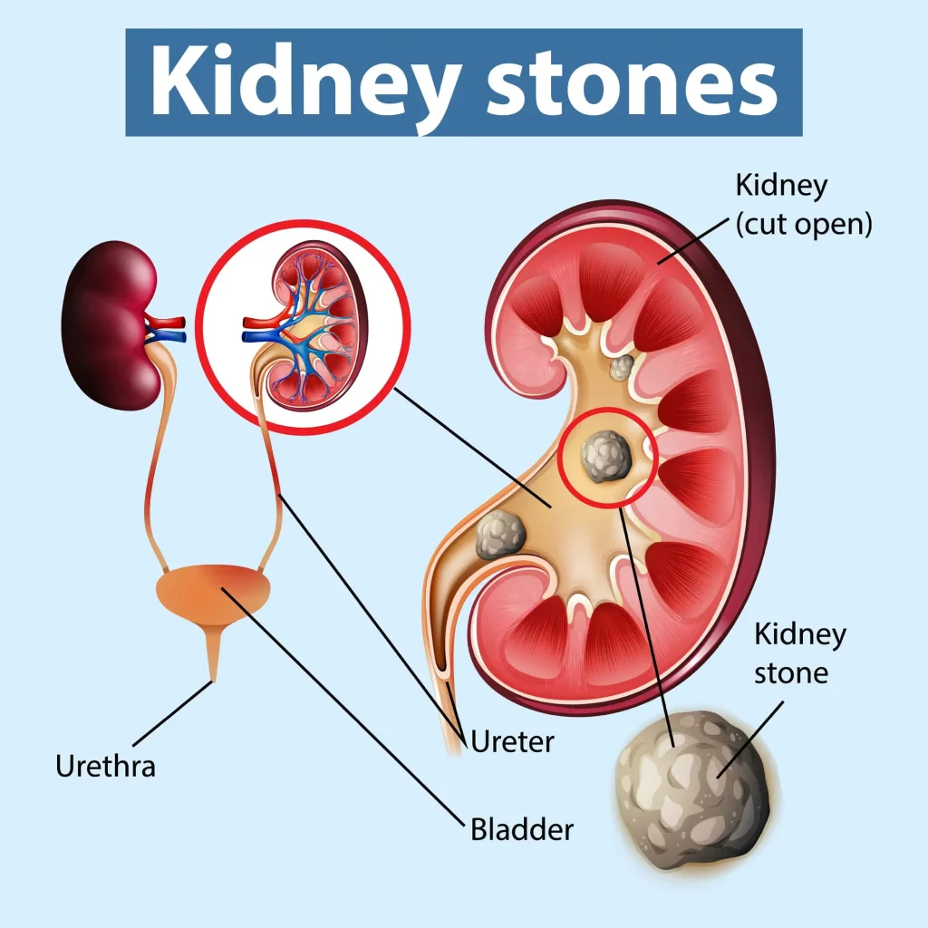 How to get rid of kidney stones