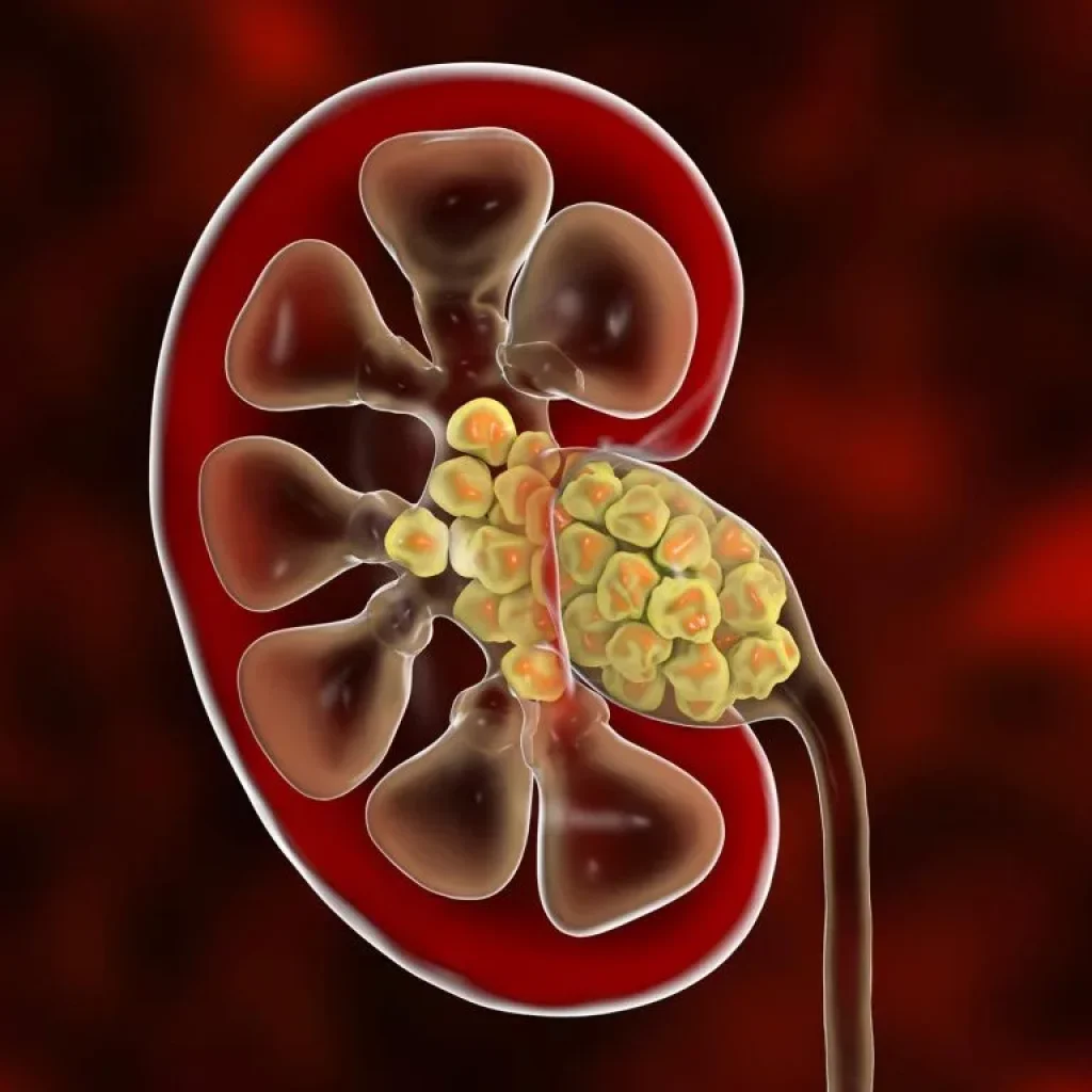 Why Kidney Failure happens