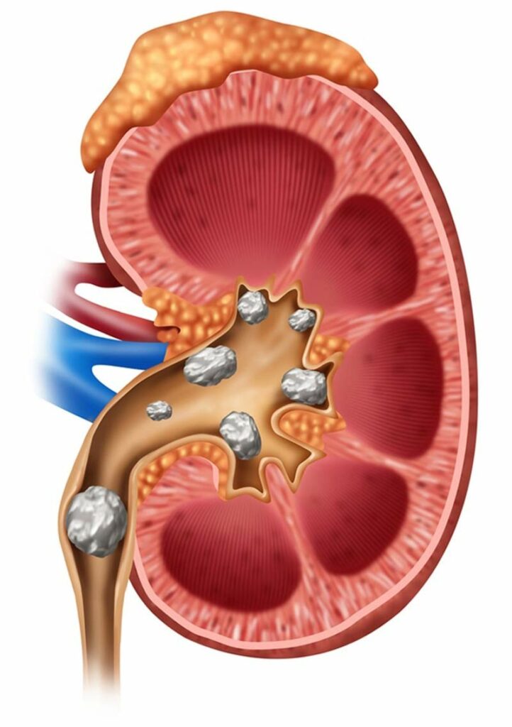 Diagnosis of Kidney Stones